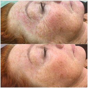Mesogel before and after
