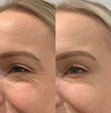 بهترین کلینیک تزریق بوتاکس در تهرانپارس