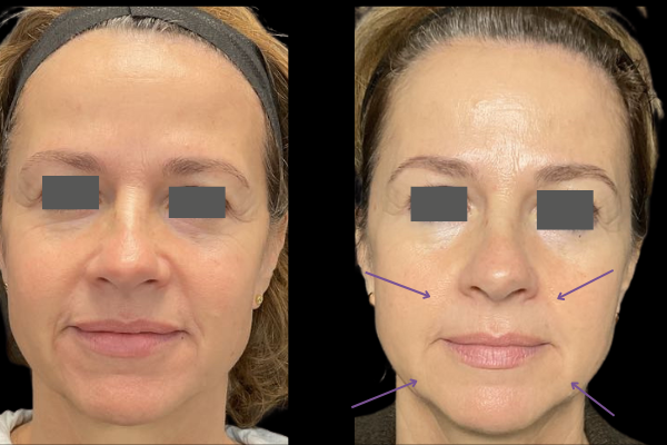 لیزر ایندولیفت صورت